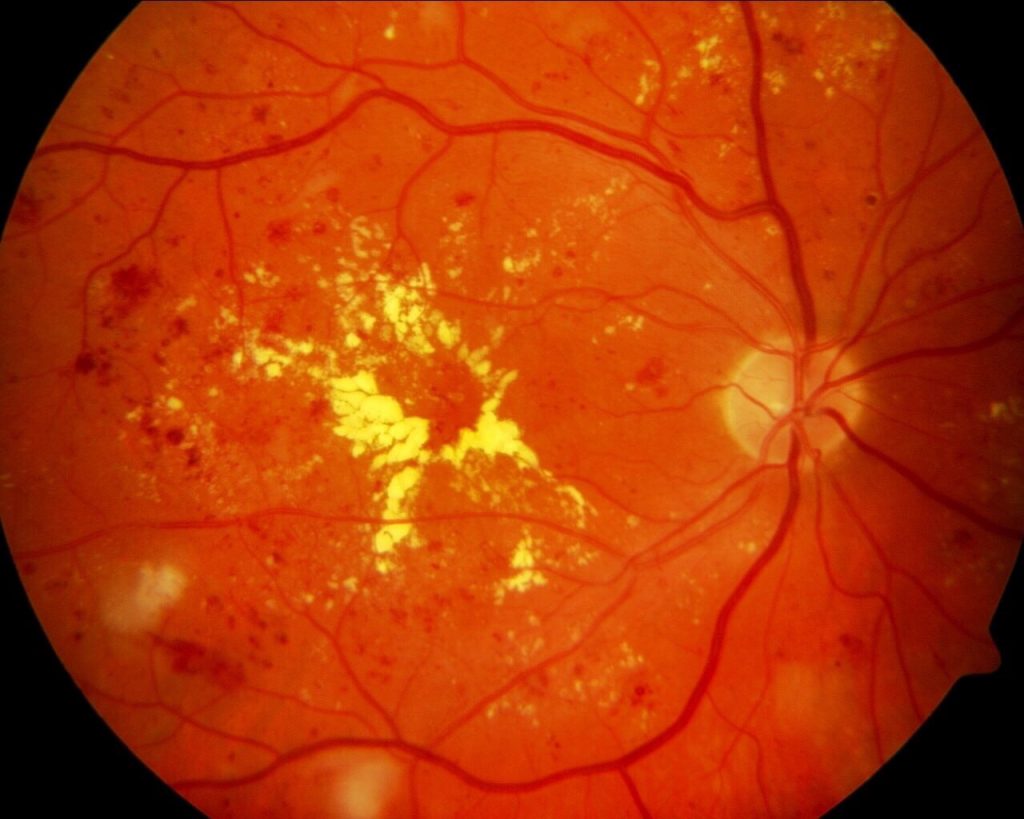 Ghana’s Most Advanced Retina Clinic Ghana’s Most Advanced Retina Clinic