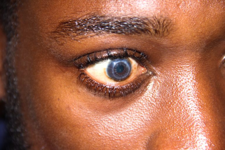 St Thomas Supports Corneal Transplant in Ghana St Thomas Supports Corneal Transplant in Ghana