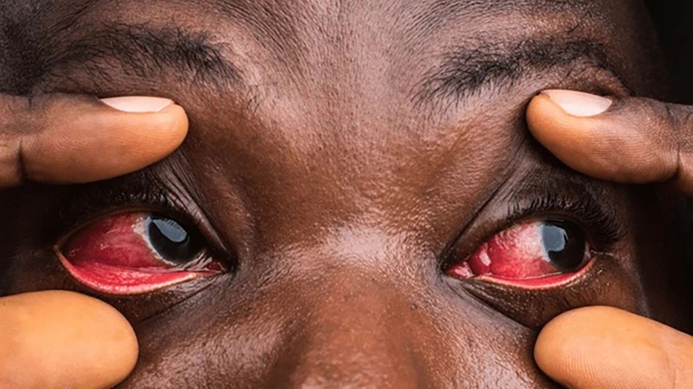 What Causes Red Eyes? 7 Common Reasons (And How St Thomas Eye Hospital Can Help) What Causes Red Eyes? 7 Common Reasons (And How St Thomas Eye Hospital Can Help)